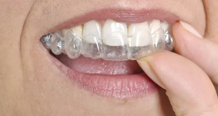 An image illustration of does Medicaid cover invisalign